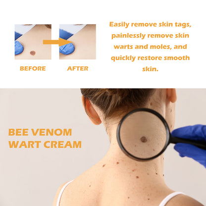 Ximonth Bee Venom Wart Cream, Repair Smooth Skin Lightening Nevus Spot Nevus Cure Wart Care Cream Health Eprolo https://www.cyberehub.com